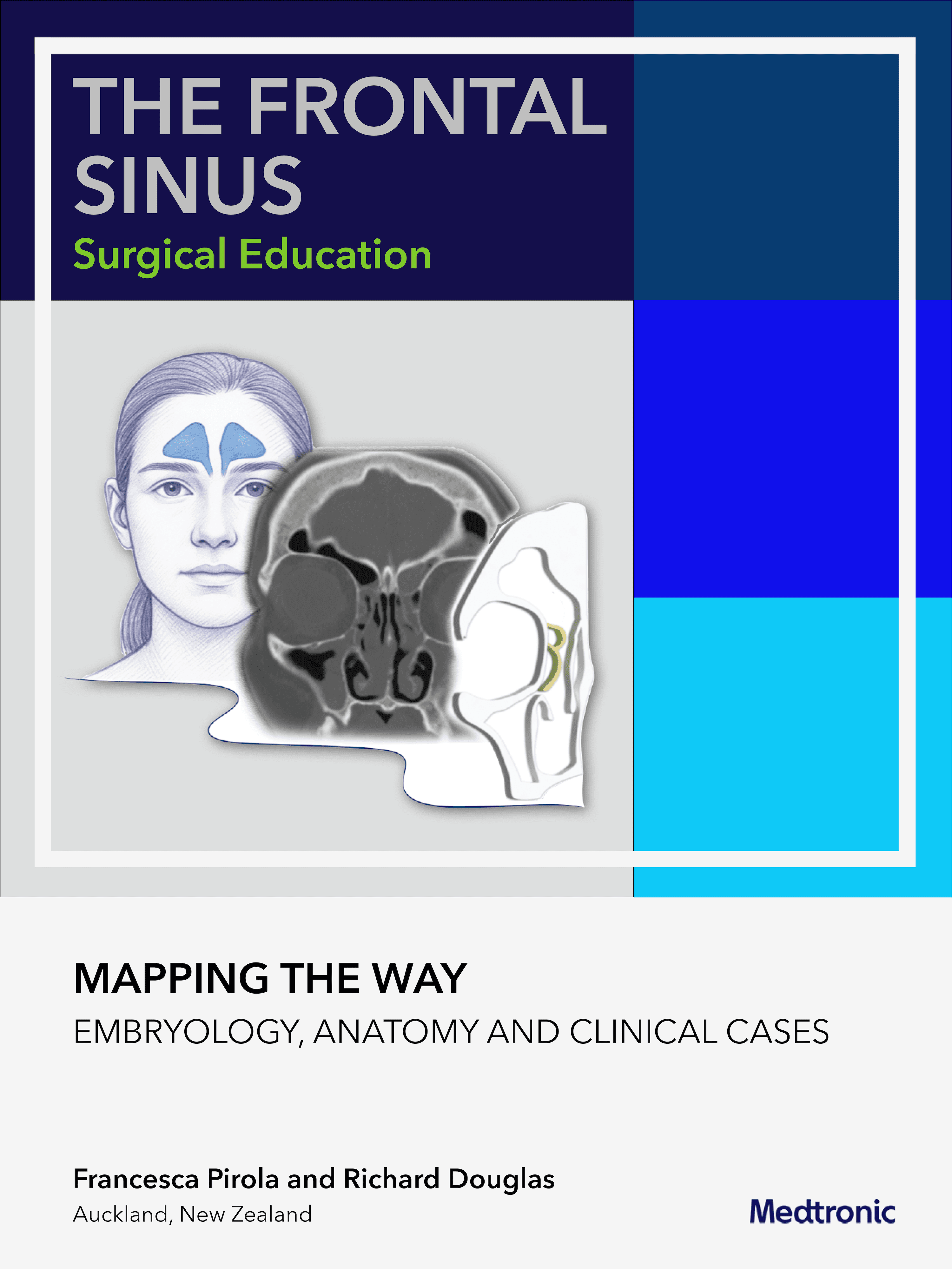 Frontal Sinus Surgery | Mapping the Way